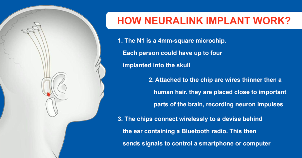 How Neuralink Implant work?
Neuralink Process for installation