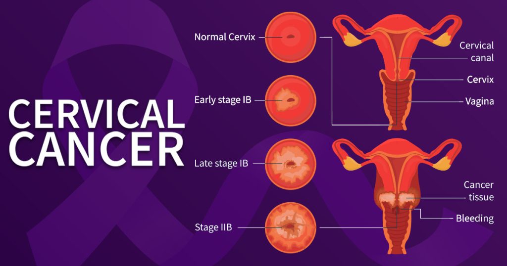 Cervical Cancer | Poonam Pandey